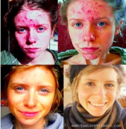 Acne before and after-250