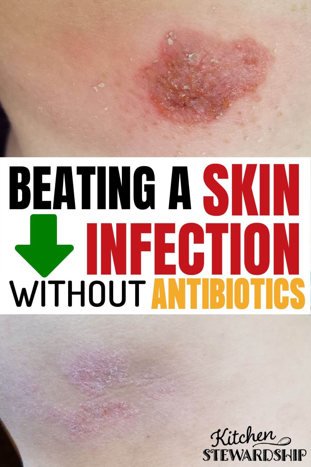 Antibiotics have a place, but I didn't want to take them unnecessarily and I instead opted for treating cellulitis naturally. beating a skin infection without antibiotics